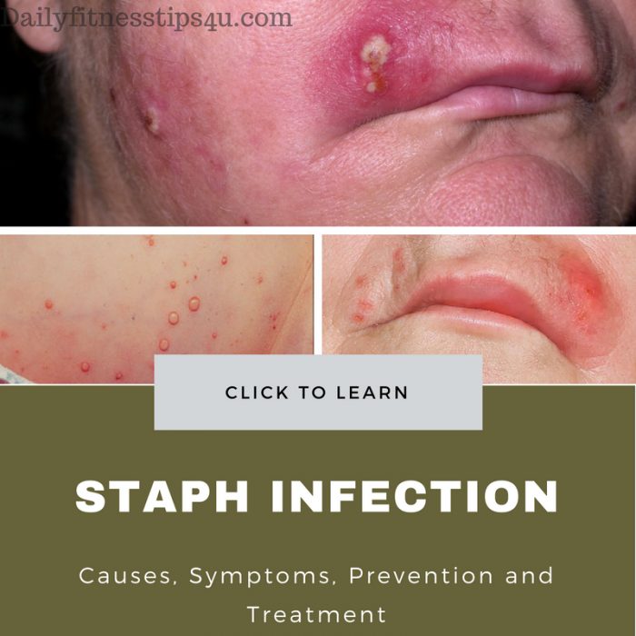 Staph Infection 1 e1526339039222
