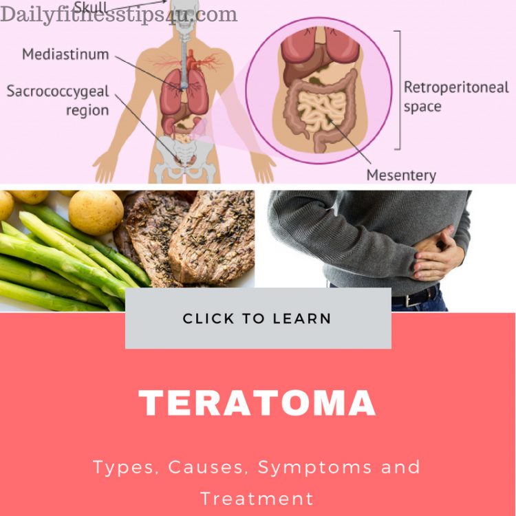 Teratoma Causes Treatment e1525983842617