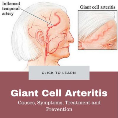 Giant Cell Arteritis Causes Treatment e1526412852654