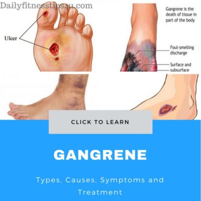 Gangrene : Types, Causes, Symptoms And Treatment