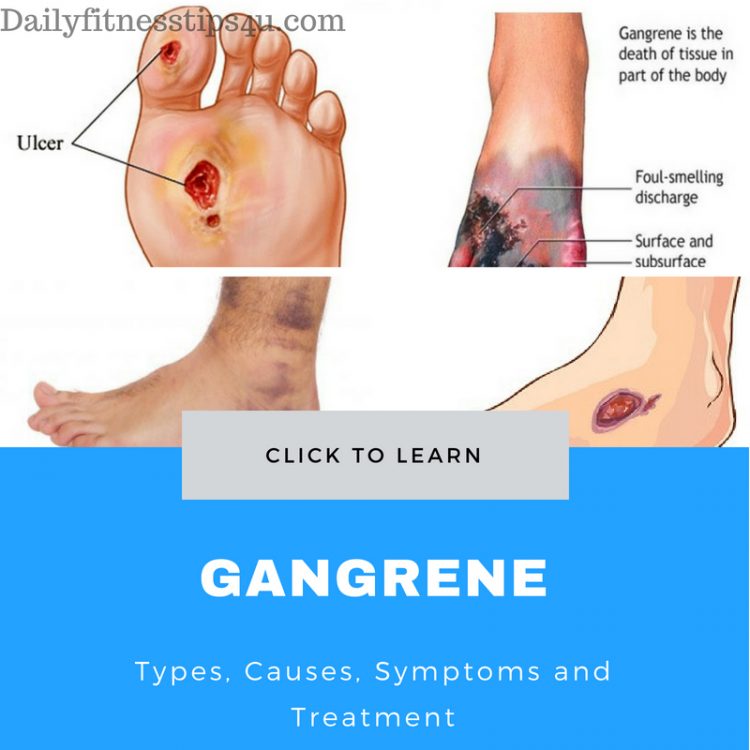 Gangrene Causes Treatment e1526288991351
