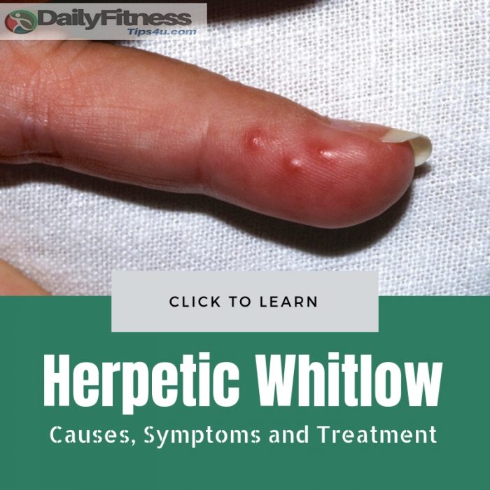Herpetic Whitlow Picture