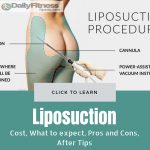 Liposuction Procedure