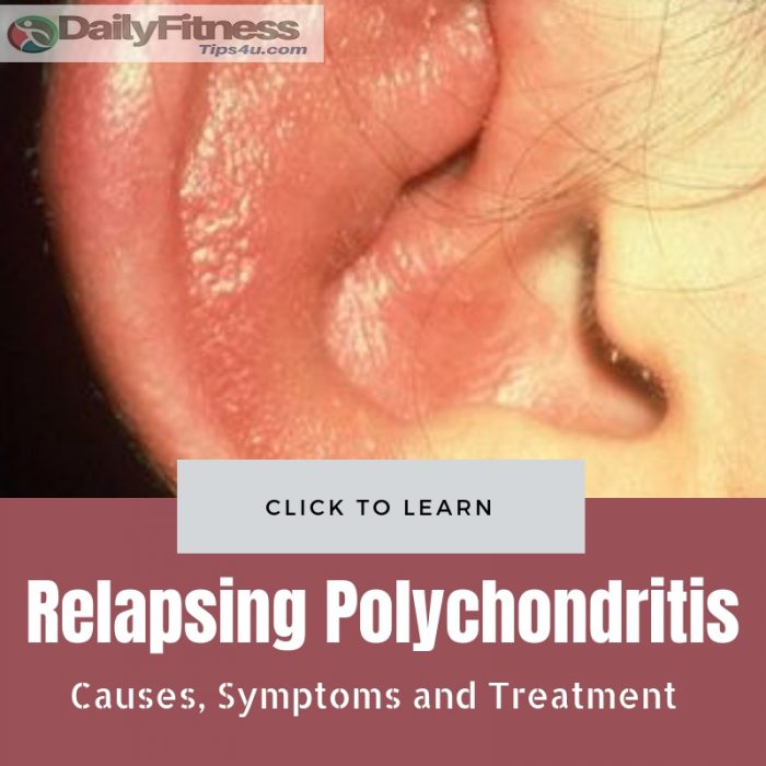 Relapsing Polychondritis