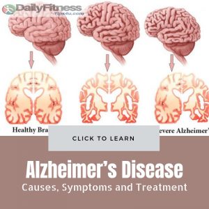Alzheimer’s Disease : Causes, Pictures, Symptoms And Treatment