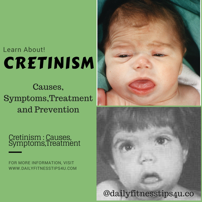 Cretinism Causes SymptomsTreatment