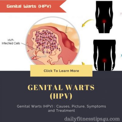 Genital Warts HPV Causes Picture Symptoms and Treatment e1522413466848
