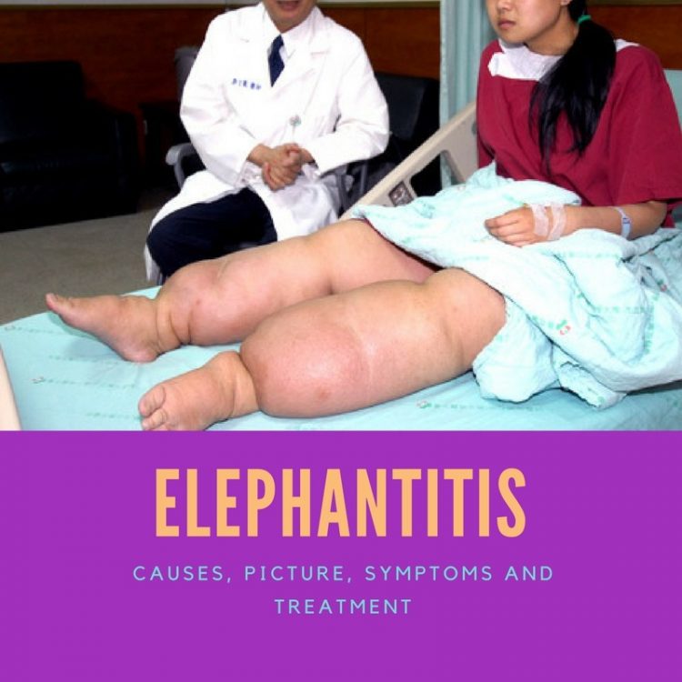 Elephantitis disease e1523868436948