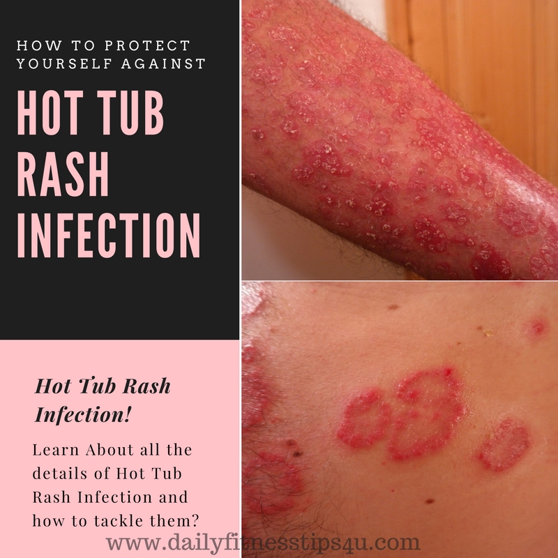 Hot Tub Rash Infection