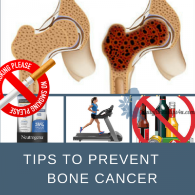 BONE-CANCER