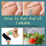How to Get Rid of Cellulite