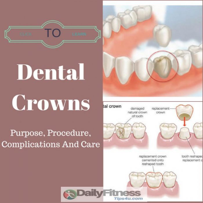 Dental Crown Purpose, Procedure, Complications And Care