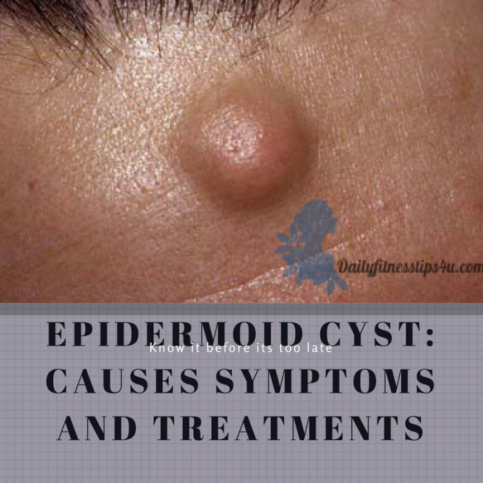 Epidermal cyst_causes