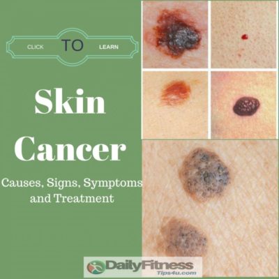 Skin Cancer Causes Treatment