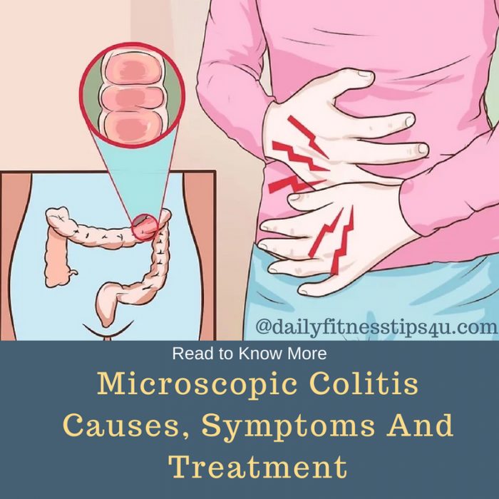 microscopic-colitis