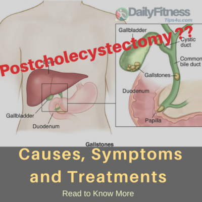 Postcholecystectomy Syndrome