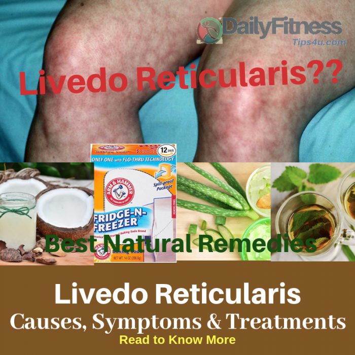 Livedo Reticularis