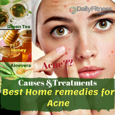 Acne - Definition, Causes , Home Remedies And Prevention