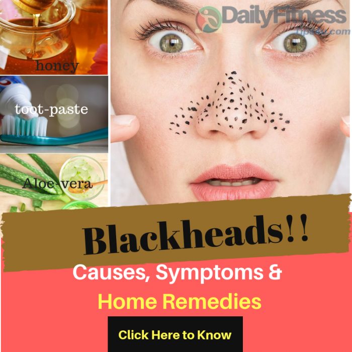 Blackheads