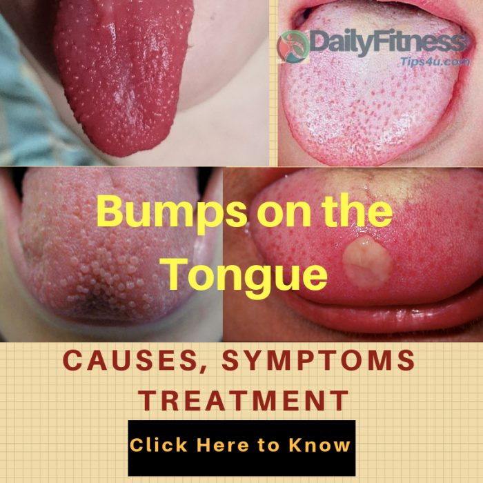 Cancer Bumps On Tongue