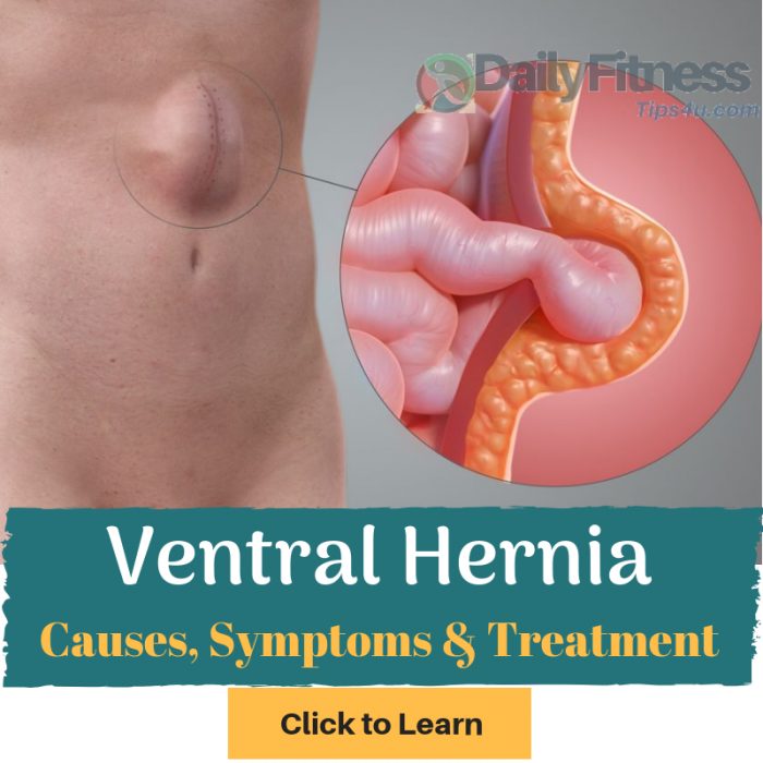 Ventral Hernia