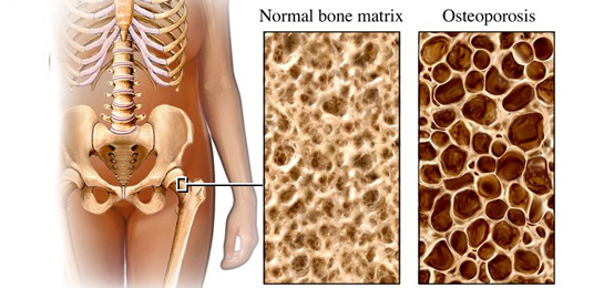 Bone Density and Bone Strength