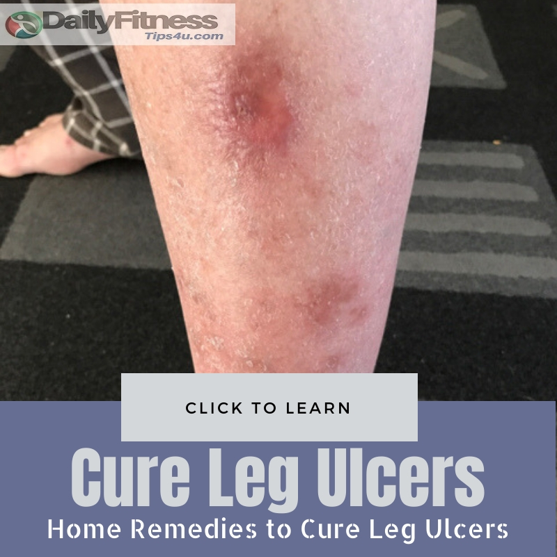 Cure Leg Ulcers