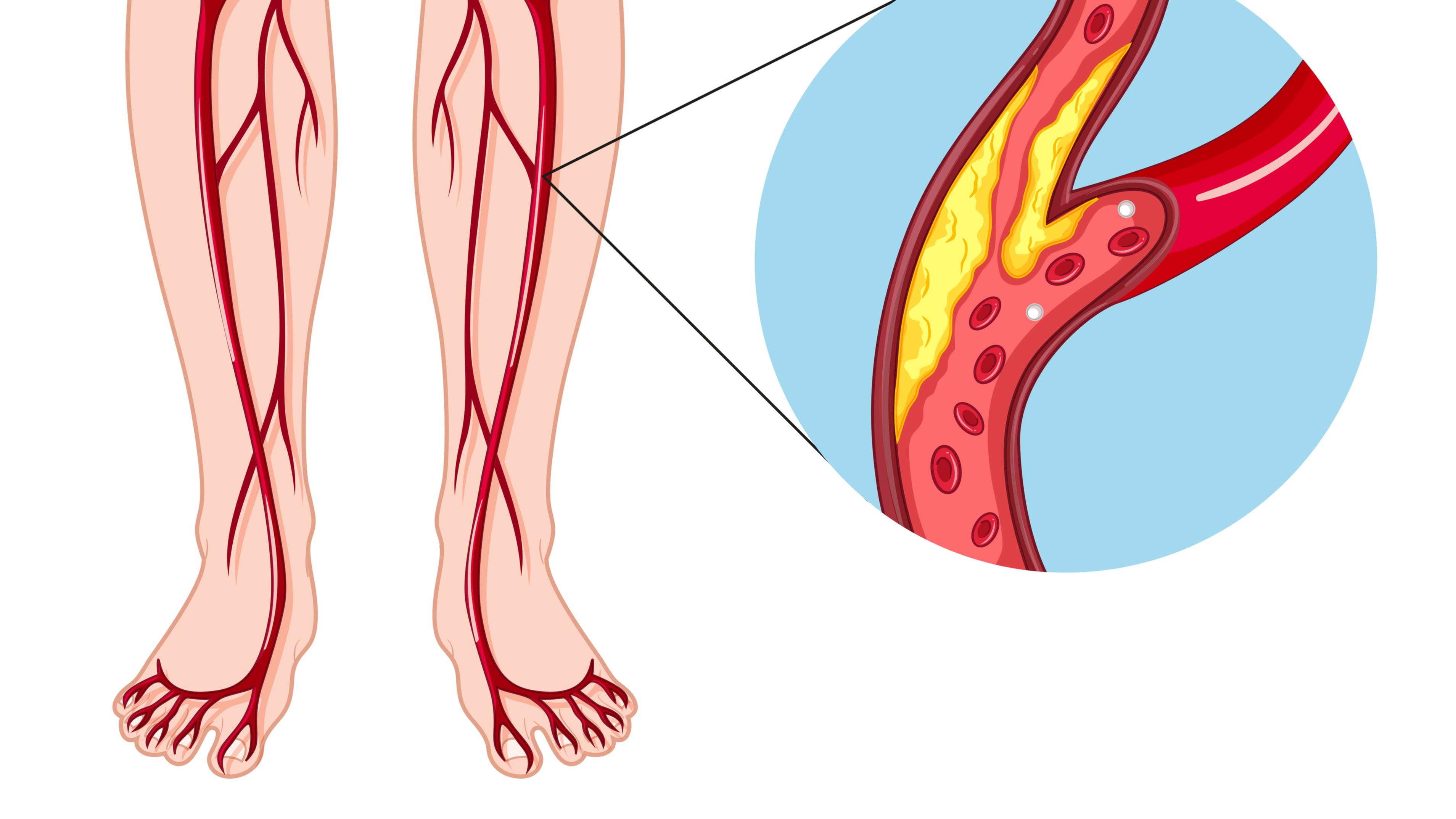 Arterial Disease