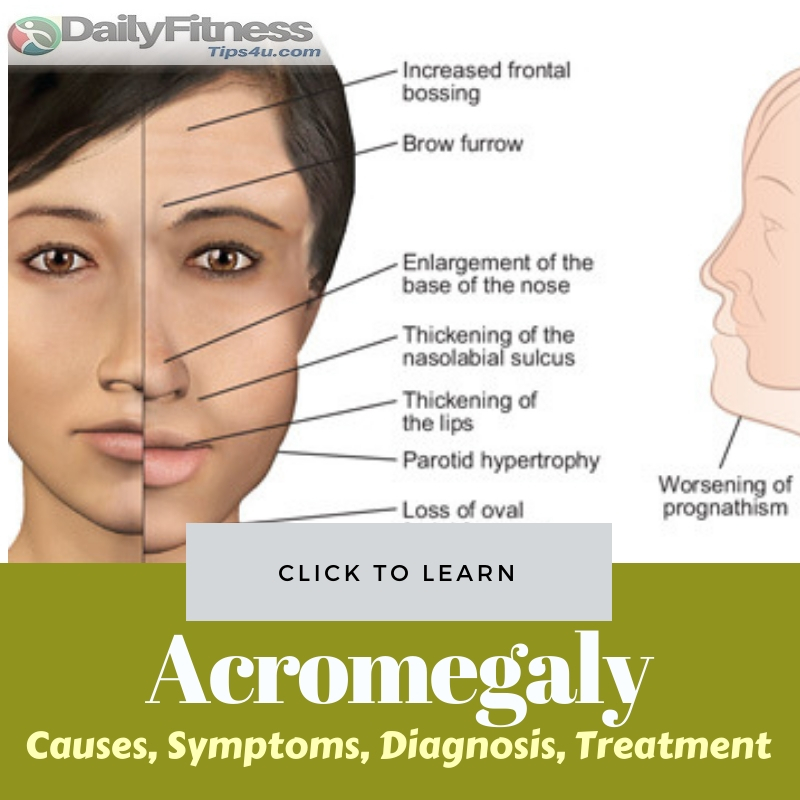 Acromegaly Causes Treatment