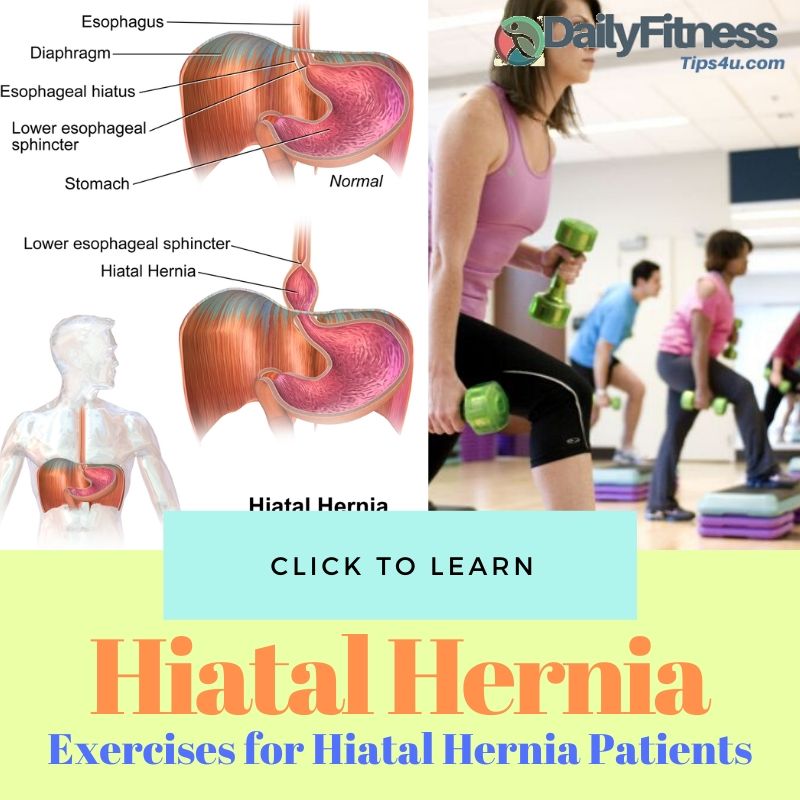 Exercises for Hiatal Hernia Patients