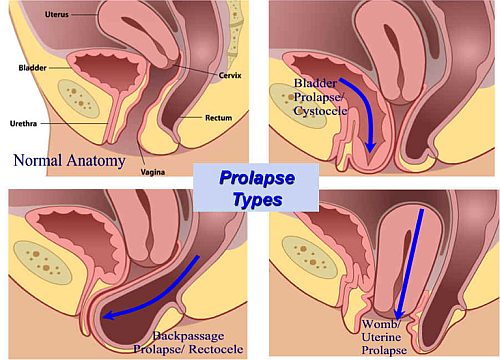 prolapse types